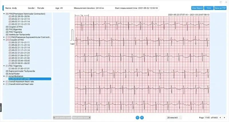 viatom-er1-lb-24-oras-ekg-holter-rogzito-mobil-ekg-holter-elektrokardiogram