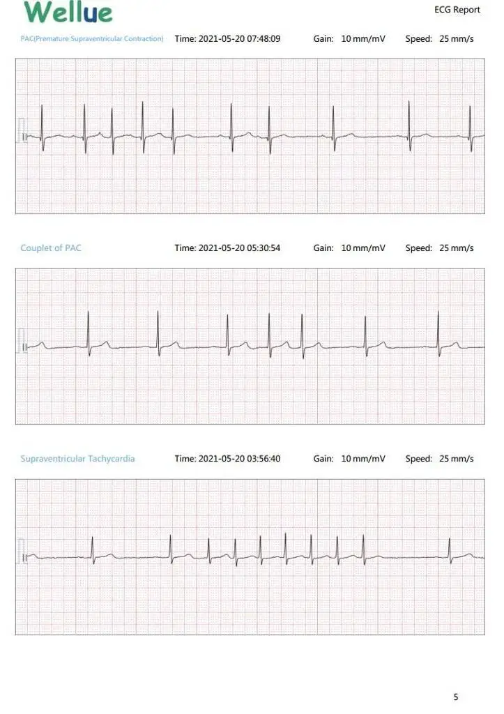viatom-lepod-pro-er3-12-elvezeteses-24-oras-mini-ekg-holter-monitor-ekg-riport