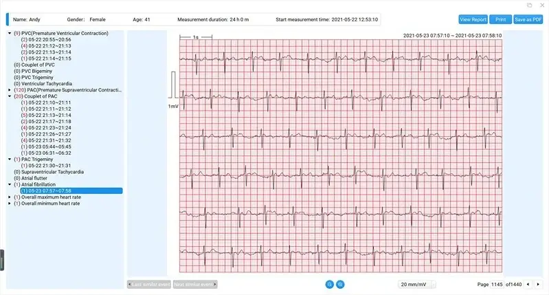 viatom-lepod-pro-er3-12-elvezeteses-24-oras-mini-ekg-holter-monitor-ekg-riport